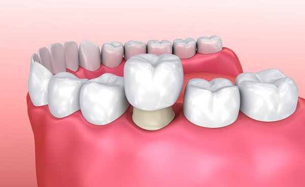 Same Day Crowns: The Pros And Cons