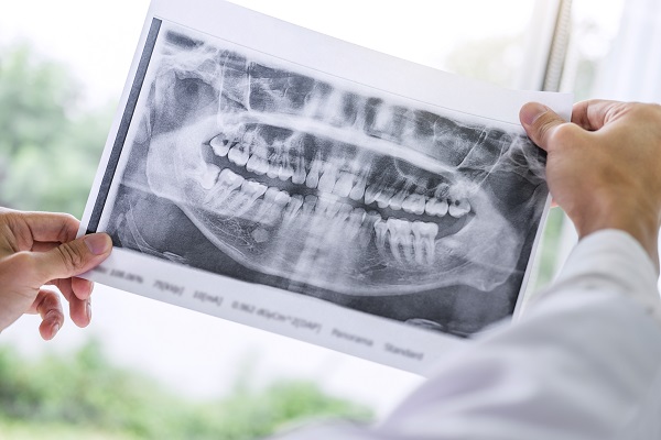 Dental Implant Restorations Babylon, NY