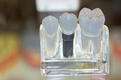 Longevity Of Dental Implants