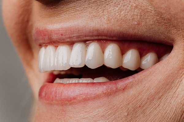 Pros And Cons Of Dental Veneers