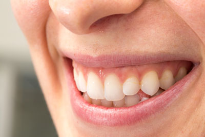 Are Dental Sealants Safe?