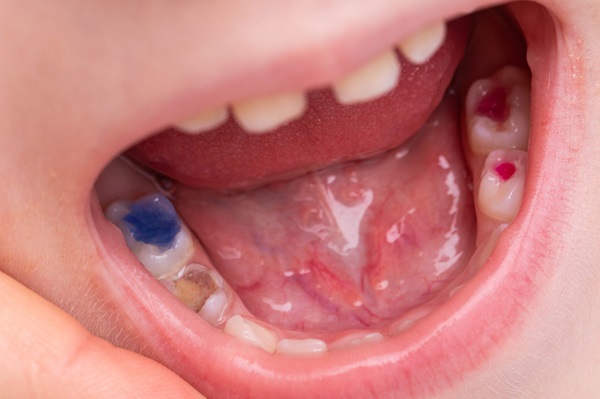 How Tooth Colored Fillings Can Restore Your Smile