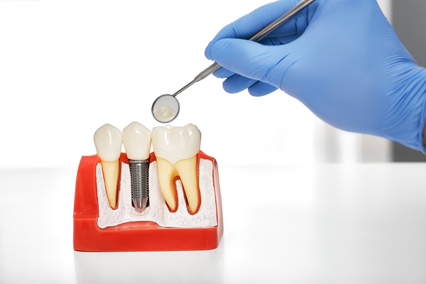 Implant Dentistry FAQs About Multiple Tooth Replacement