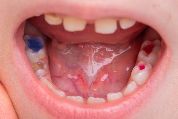 FAQs About Tooth Colored Fillings